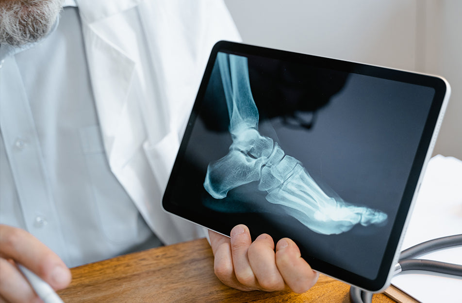 Heel Spurs: Causes, Symptoms, and WALK Insoles Solution